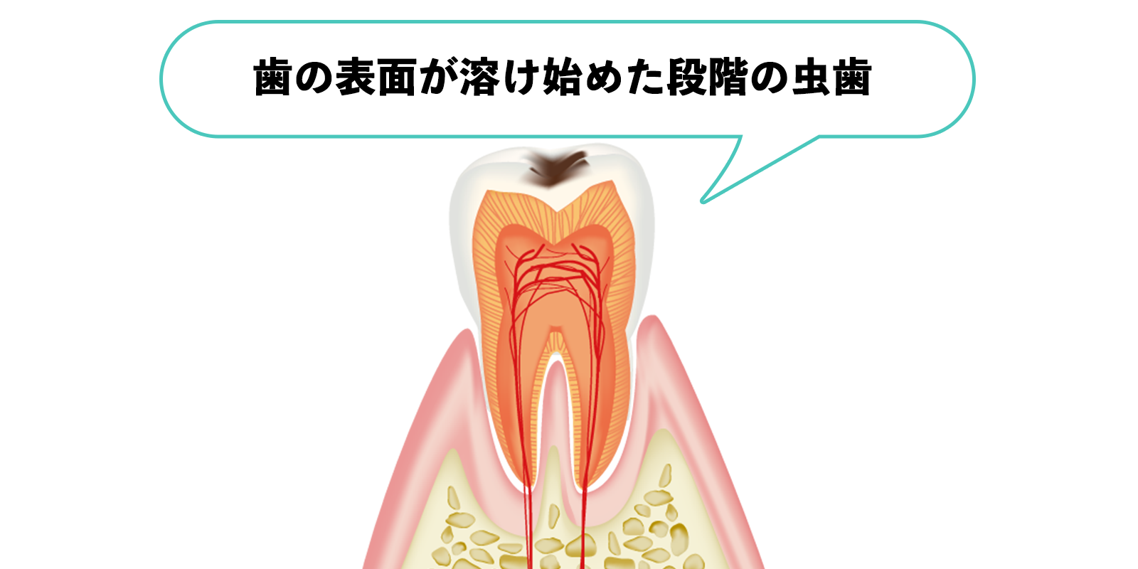 エナメル質内の虫歯