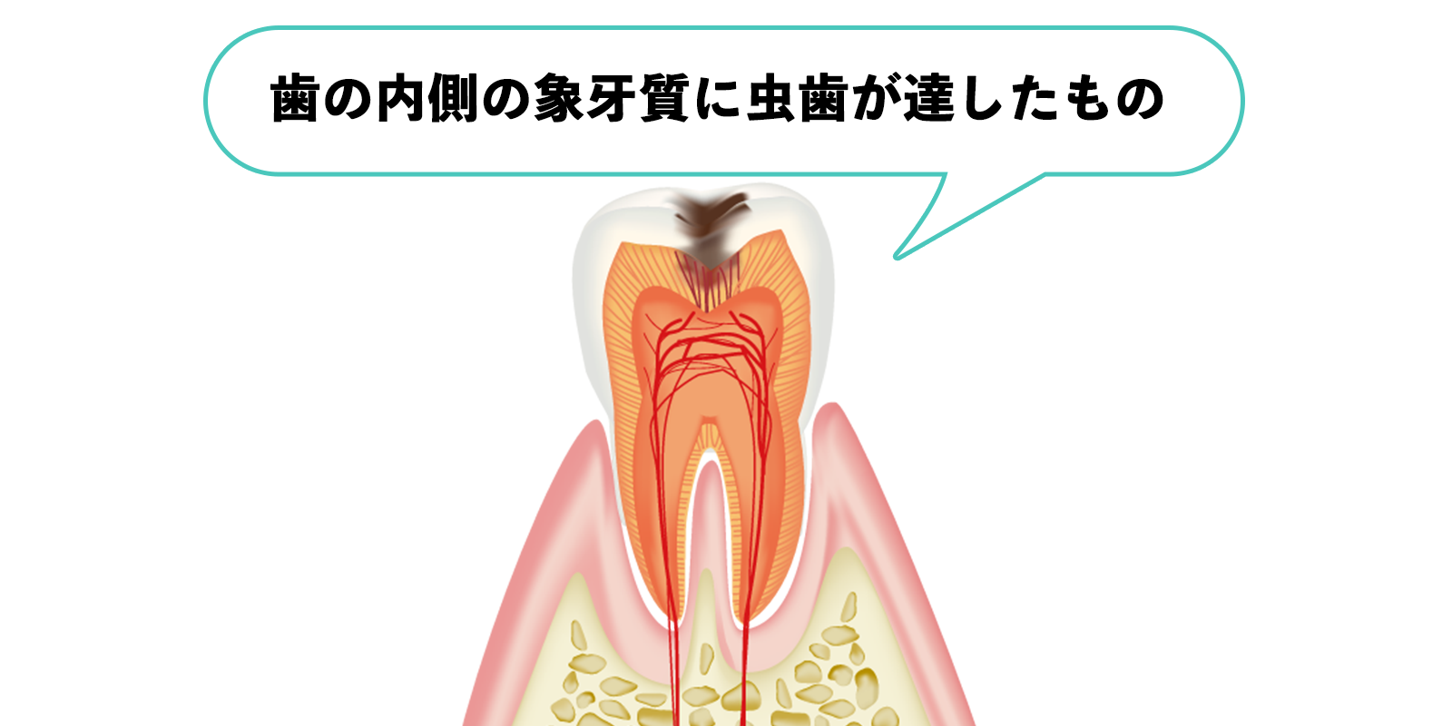 象牙質に達した虫歯