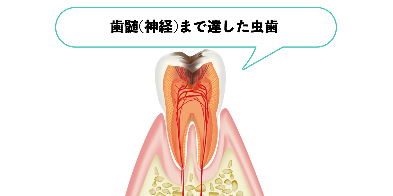 歯髄(神経)に達した虫歯